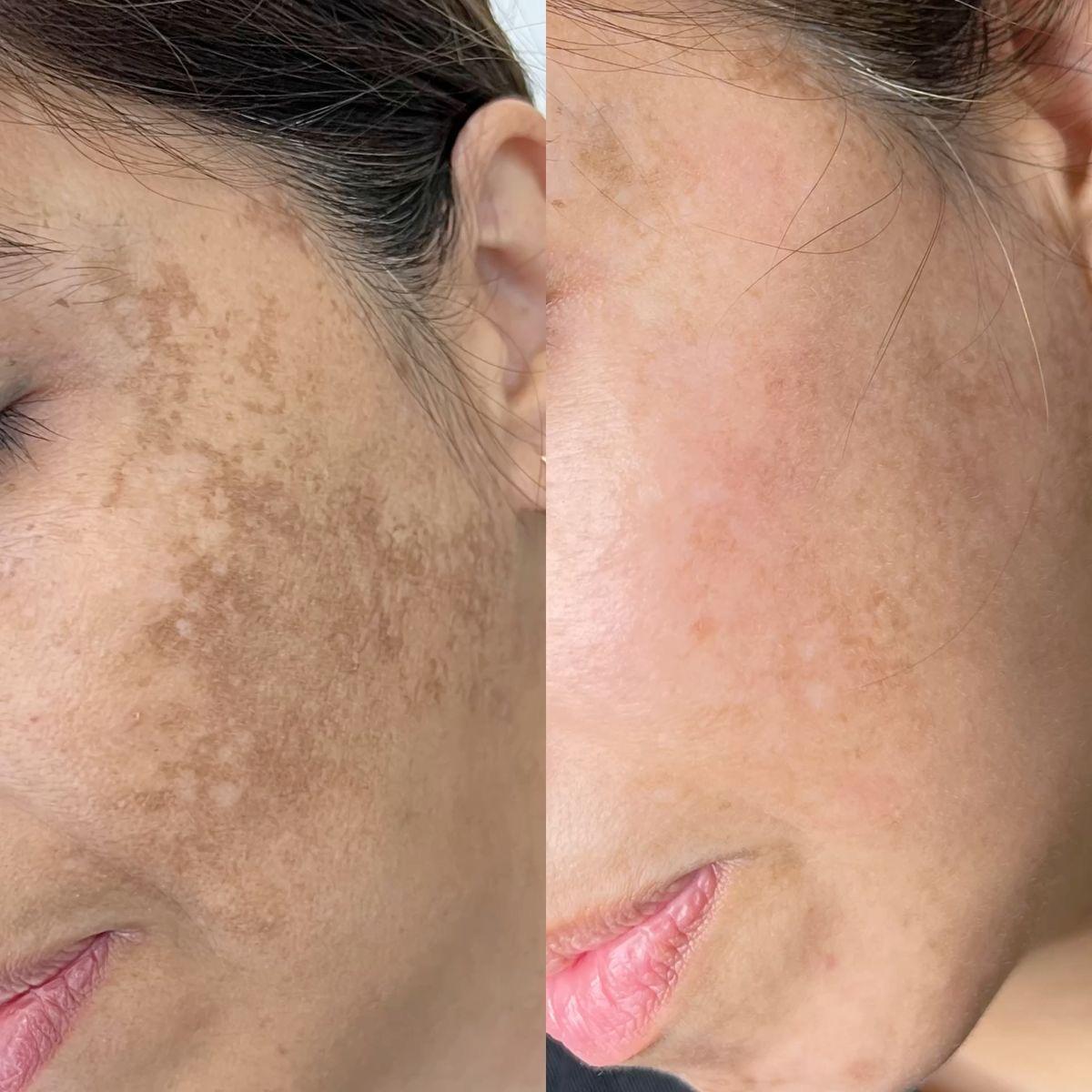 MICRO-NEEDLING